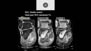 MRI of the Ankle Part 12 – Ankle Impingement [upl. by Atirehs]