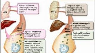 alpha 1 antitrypsin deficiency [upl. by Nimaj]