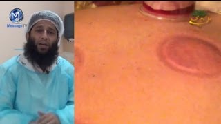 Hijama  Cupping Therapy with close up Dr Iftkhar Saifi حجامہ [upl. by Mirabelle]