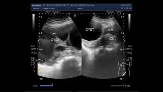 Ultrasound Video showing a large multiseptic ovarian Cyst [upl. by Dreda882]