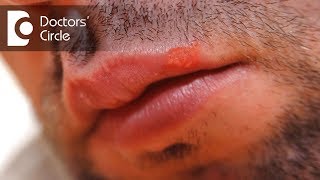 What can cause a lip blister and its management  Dr Sachith Abraham [upl. by Kotta]