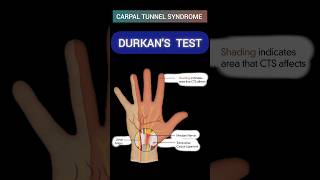 DURKANS TEST for Carpal Tunnel Syndrome🤚carpaltunnelsyndrome anatomy greysanatomy mbbs [upl. by Ggerc961]