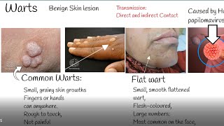 Warts causes and treatment Wart Types [upl. by Akyeluz]