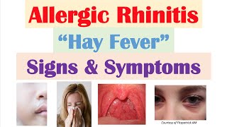 Allergic Rhinitis Hay Fever amp Seasonal Allergies Signs amp Symptoms amp Why They Occur [upl. by Brownson]