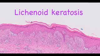 Lichenoid keratosis [upl. by Maag64]