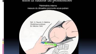 GYNECOLOGIE Examen du bassin obstetrical [upl. by Airotal]