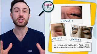 Face the Case Periorbital Swellings due to Neurotoxin Injections [upl. by Aiuoqes]