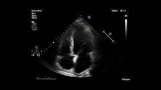 Cardiac Ultrasonogram Showing Apical 4 Chamber View [upl. by Keslie]