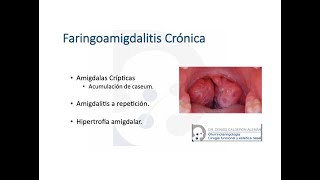 6 Faringoamigdalitis cronica [upl. by Aicertap]