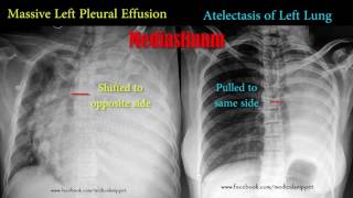 pleural effusion vs atelectasis [upl. by Almira]