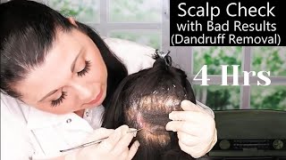 ASMR Scalp Check with Bad Results Compilation Dandruff Removal Scalp Treatment Medical Roleplay [upl. by Nesnaj]