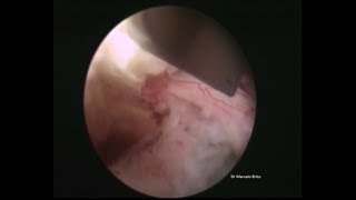 Spine Osteophyte Removal  Endoscopic Surgery [upl. by Aneehc]