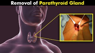 How Parathyroid Gland Surgery Is Performed UrduHindi [upl. by Donegan]