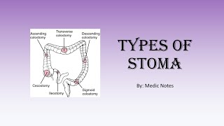 Types of stoma  colostomyileostomyurostomy endloopdoublebarrel temporarypermanent [upl. by Harlamert]