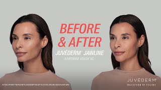 A Smooth Contour In The Jawline With JUVÉDERM® Filler  Lara’s Before amp After [upl. by Bonacci]