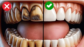 9 Natural Ways To Remove Plaque And Tartar From Your Teeth [upl. by Valentijn]