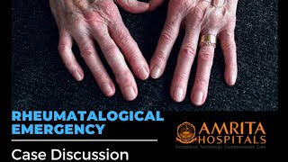 Case Discussion  Rheumatological Emergency  Rheumatoid Arthritis [upl. by Ahsiki790]