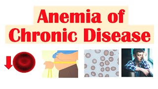 Anemia of Chronic Disease  Causes Pathophysiology Signs amp Symptoms Diagnosis Treatment [upl. by Damian]