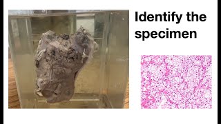 Pathology specimen Renal Cell Carcinoma [upl. by Sharron998]