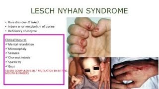 Lesch Nyhan syndrome A defect of Hypoxanthine Guanine phosphoribosyltransferase enzyme [upl. by Gerek]