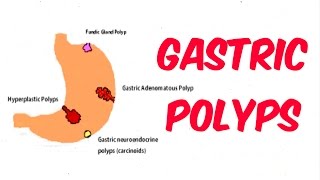 Gastric Stomach Polyps [upl. by Nneb]