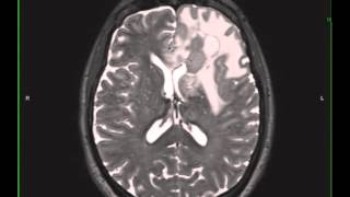 Grade 3 Anaplastic Astrocytoma [upl. by Enaitsirk]