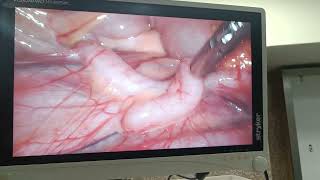 ureteric peristalsis during laparoscopic surgery [upl. by Selby]