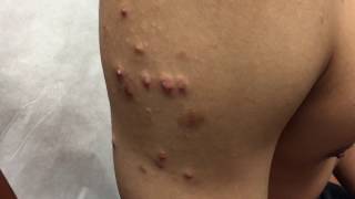 Successful Treatment of Keloid in San Antonio Boerne by Cryo Surgery Texas Institute of Dermatology [upl. by Nirik799]