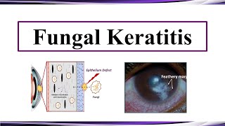 Fungal Keratitis [upl. by Gilead]