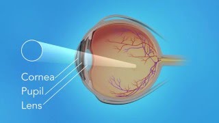 Detached Retina Pneumatic Retinopexy [upl. by Auguste]