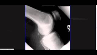 Interpreting XRays of the Knee Joint [upl. by Egiap]