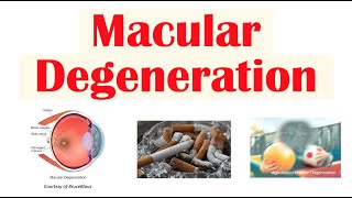 Macular Degeneration  Wet vs Dry  Risk Factors Pathophysiology Symptoms Diagnosis Treatment [upl. by Nam370]