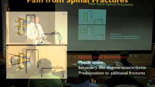 UCSF Radiology Spinal Fractures and Spinal Disorders [upl. by Newel]