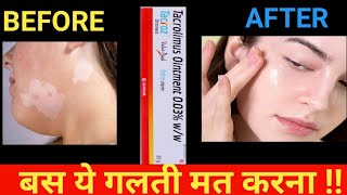 tacroz ointment use in hindi  tacrolimus ointment [upl. by Yltneb]