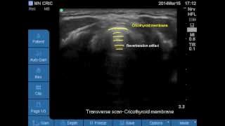 Ultrasound Airway anatomy Vocal cords Cricothyroid membrane Cricoid [upl. by Anrahc]