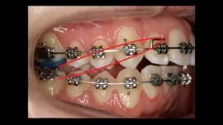 Uso de los elásticos en Ortodoncia Fija [upl. by Cele]