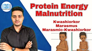 Protein Energy Malnutrition  Kwashiorkor Vs Marasmus [upl. by Hcelemile]