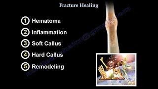 Fracture Healing  Everything You Need To Know  Dr Nabil Ebraheim [upl. by Orman]