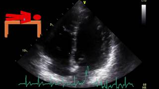 Echocardiogram Orthostasis Highly Reactive Heart Rate [upl. by Ted]