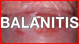 Balanitis Symptoms Causes Treatment and Prevention [upl. by Amirak]