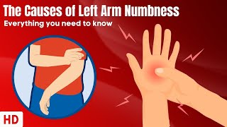 The Causes Of Left Arm Numbness [upl. by Mahon941]