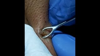 LARGE DEEP BLACKHEAD on back squeezed out Original ASMR [upl. by Lemej]