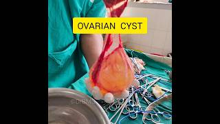 3 Advanced Ovarian Cyst Ultrasound Features to Master ultrasound ovariancyst [upl. by Gnilyarg]