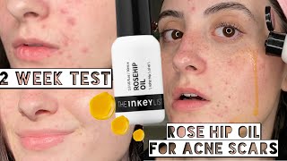 I TESTED THE INKEY LIST ROSE HIP OIL ON MY ACNE SCARS FOR 2 WEEKS  Dry Sensitive Acne Skin [upl. by Nioe]