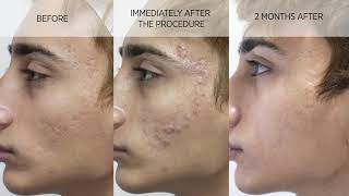 Acne scar subcision and filler [upl. by Lahsiv]