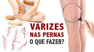 Varizes nas pernas o que fazer [upl. by Ardys]