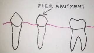 Pier Abutment in Fixed Partial Dentures [upl. by Laven]