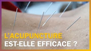 Lacupuncture estelle efficace [upl. by Cyma]