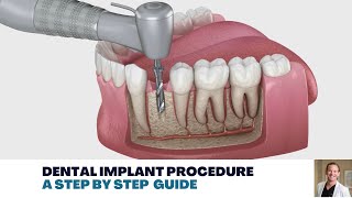 Dental Implant Procedure A Step by Step Guide [upl. by Arel]