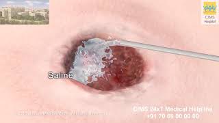 Endoscopic Gastrocnemius Recession [upl. by Clarie]